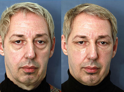 Full Face John, 49 jaar
